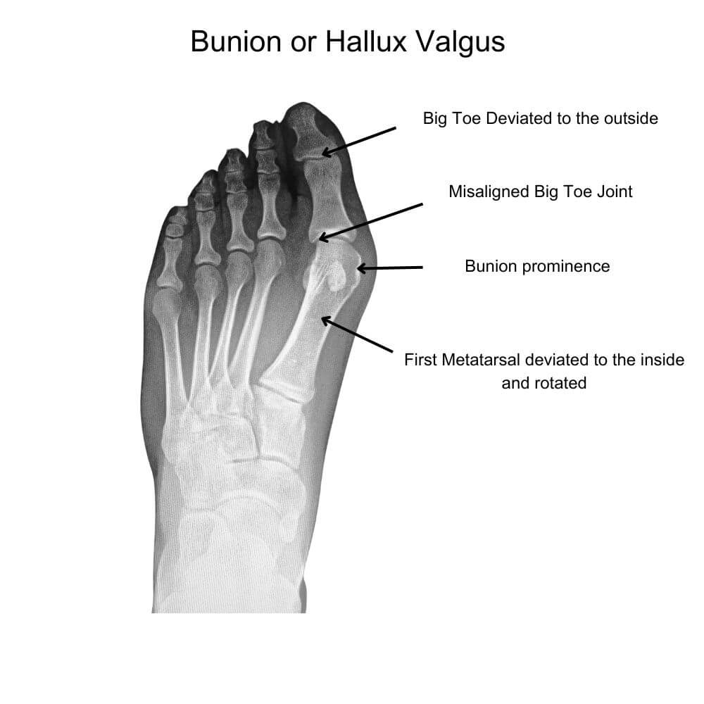 Diagram of Bunion (Hallux Valgus)