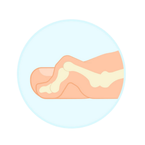 Hammertoe diagram