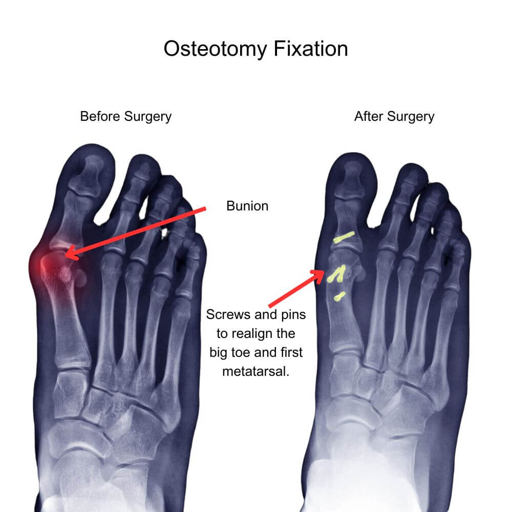 Diagram of Before and After Osteotomy Fixation