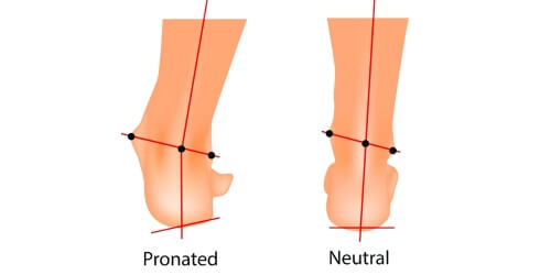 Overpronated Alignment Vs. Neutral Alignment