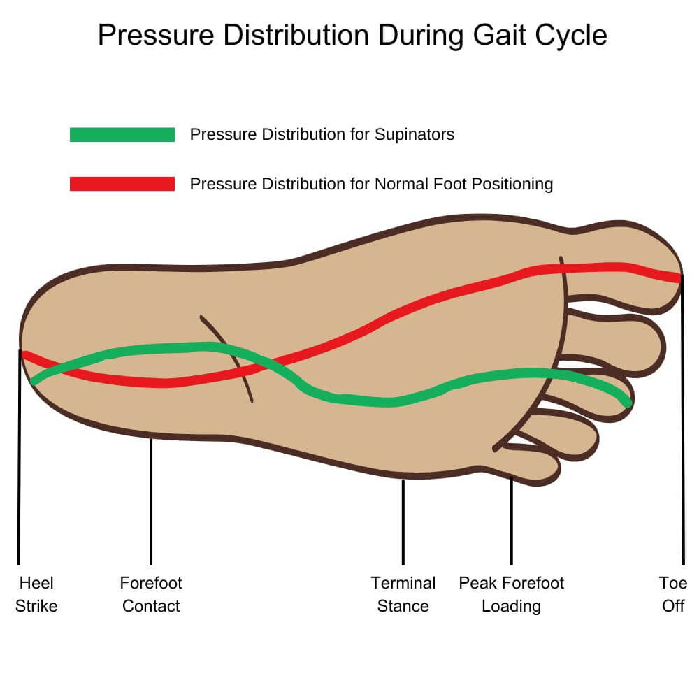 Pressure Distribution During the Gait Cycle For Normal Foot Positioning and Supinators