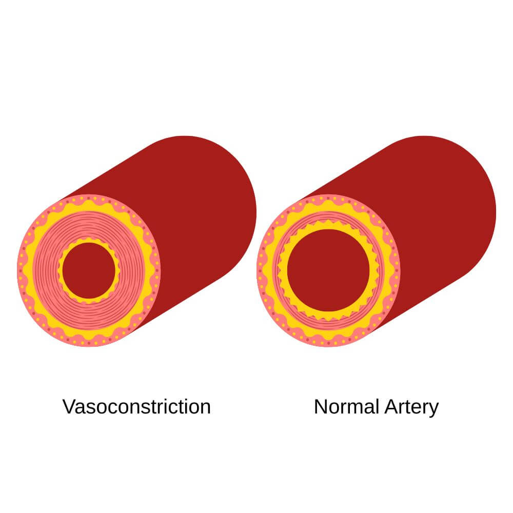Side-by-side diagram of a normal artery and a vasoconstricted artery, illustrating narrowed blood flow.
