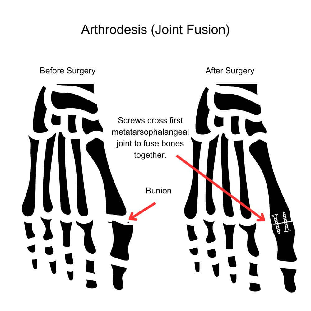 Diagram of Before and After Arthrodesis (Joint Fusion)