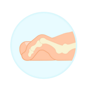 Claw Toe Diagram