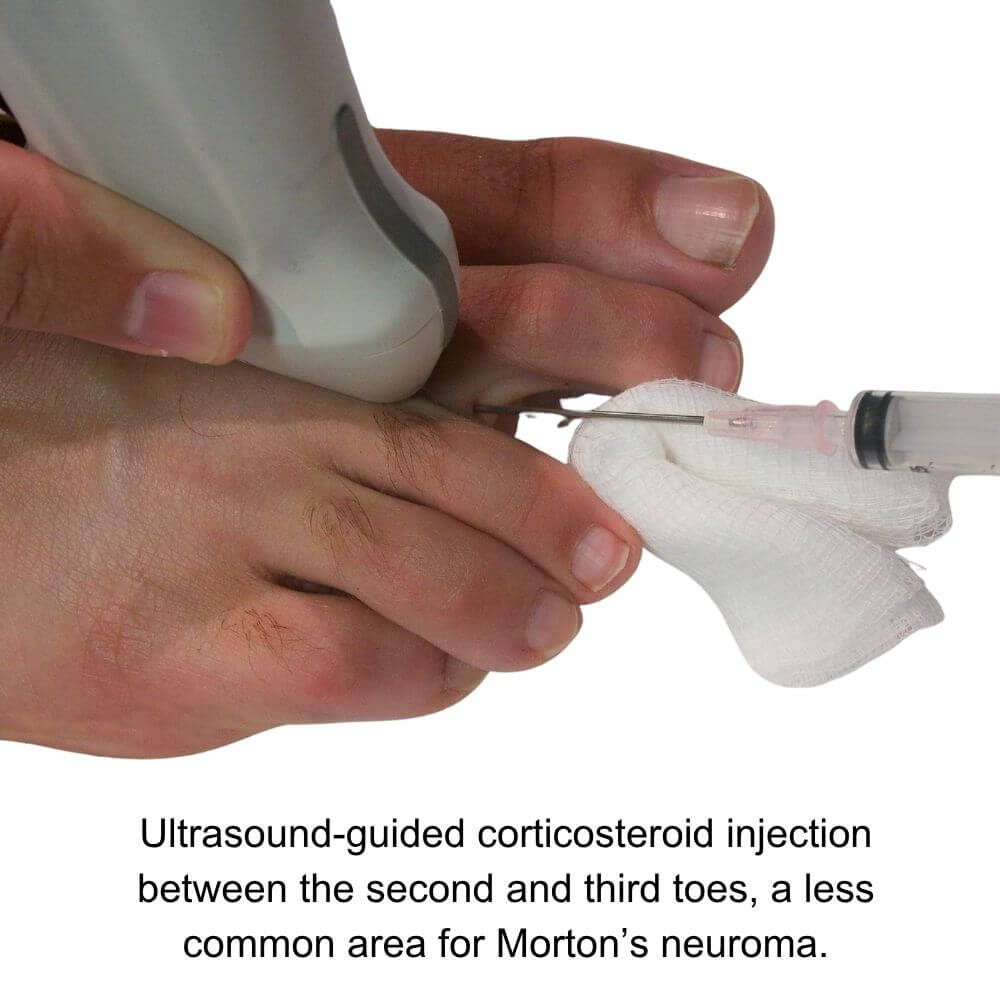Ultrasound-guided corticosteroid injection between the second and third toes used to treat Morton’s neuroma, showing needle placement and ultrasound probe on foot.