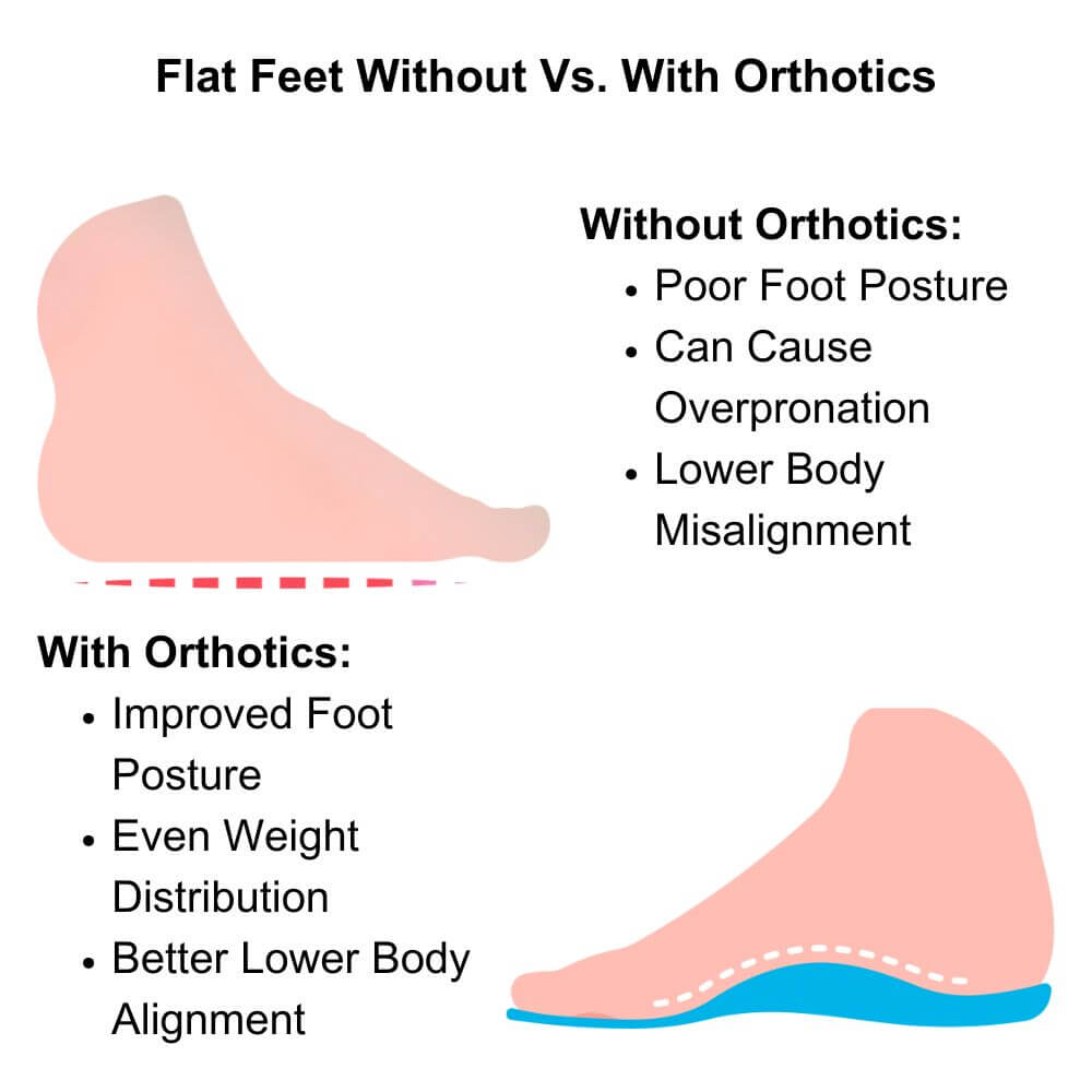 How Custom Orthotics Can Improve Flat Feet Foot Condition