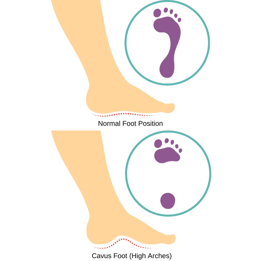 High Arches Vs Normal Arches