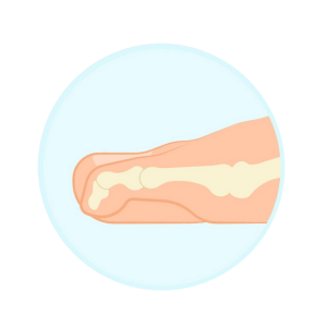 Mallet Toe Diagram