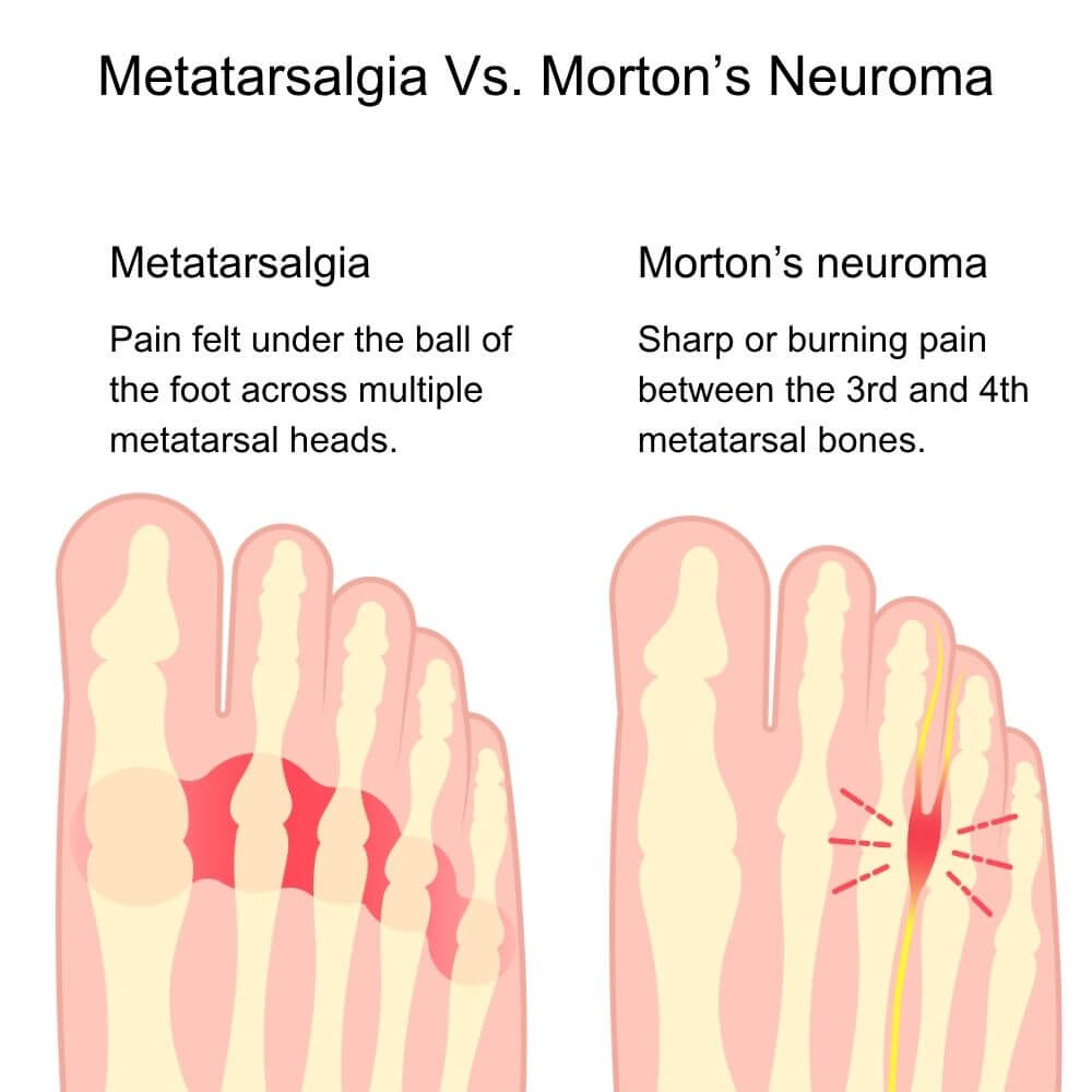 Diagram comparing metatarsalgia and Morton’s neuroma, showing pain across the ball of the foot for metatarsalgia and nerve pain between the third and fourth toes for Morton’s neuroma.
