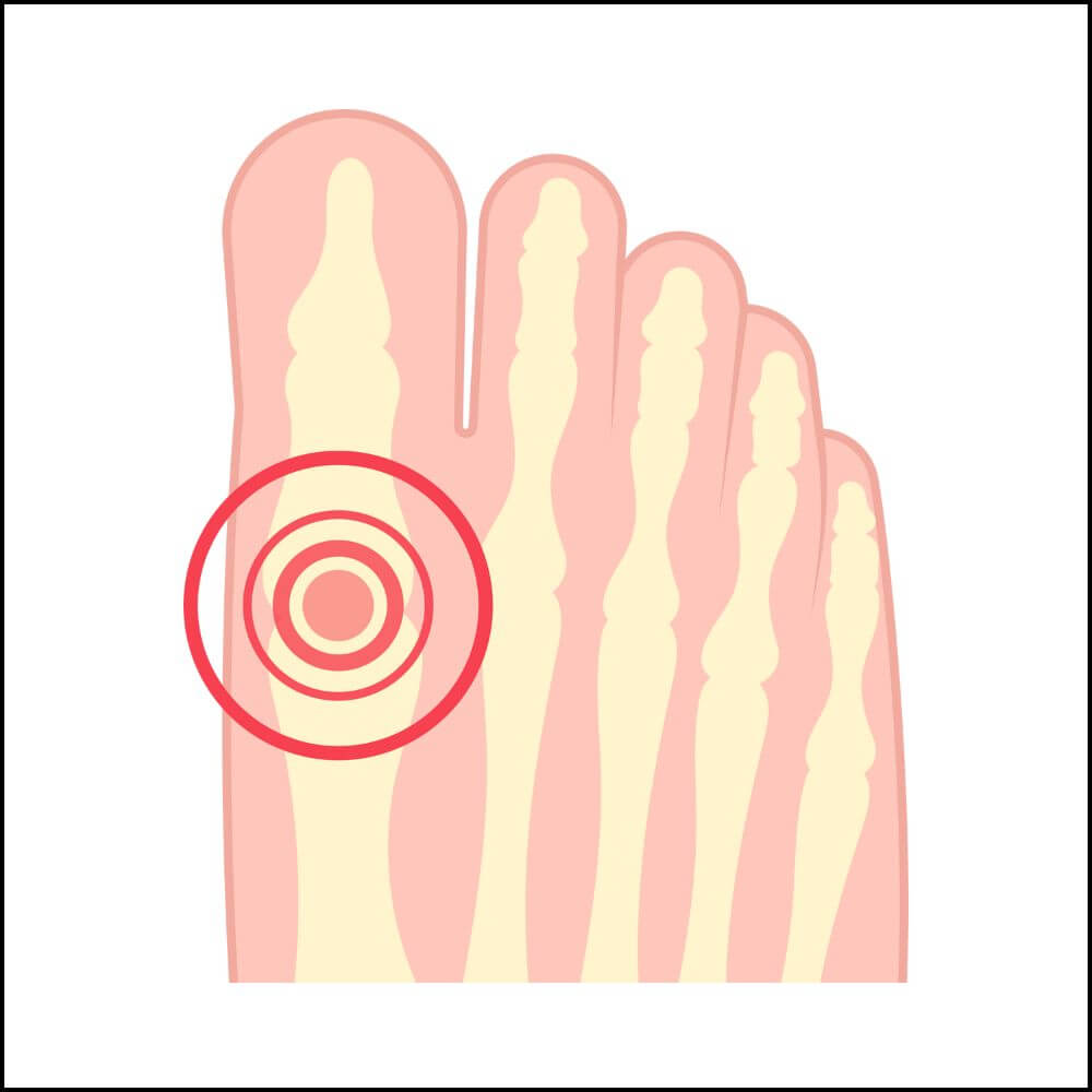 Metatarsalgia pain location