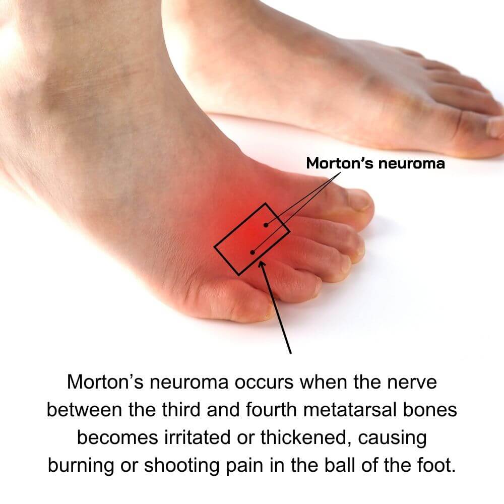 Diagram of foot showing Morton’s neuroma pain between third and fourth toes, highlighting irritated nerve in the ball of the foot.