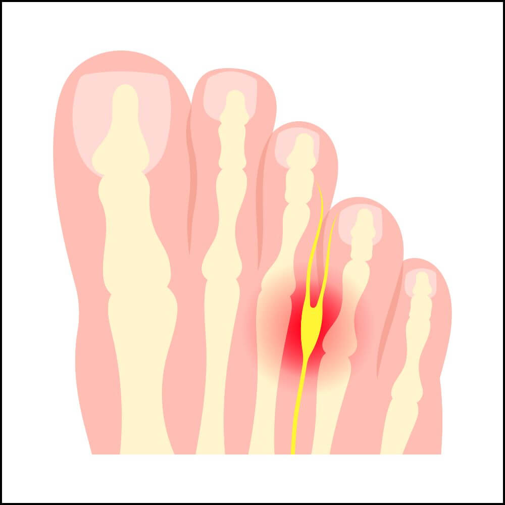 Morton's Neuroma Pain Location