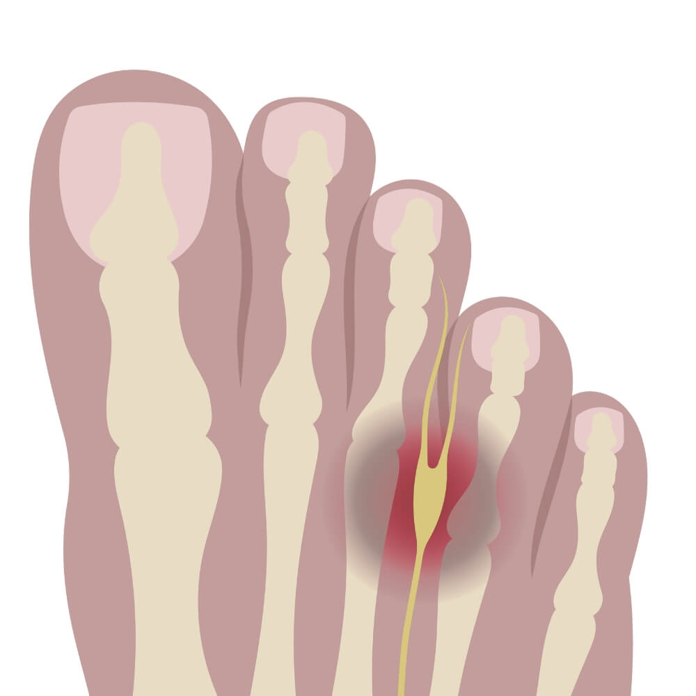 Diagram of Morton’s neuroma showing inflamed nerve between third and fourth toes, illustrating common pain location in the ball of the foot.