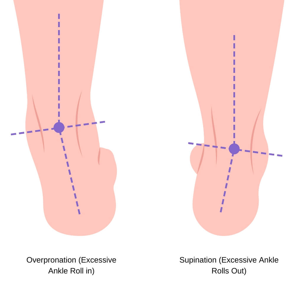 Overpronation Vs. Supination Stance