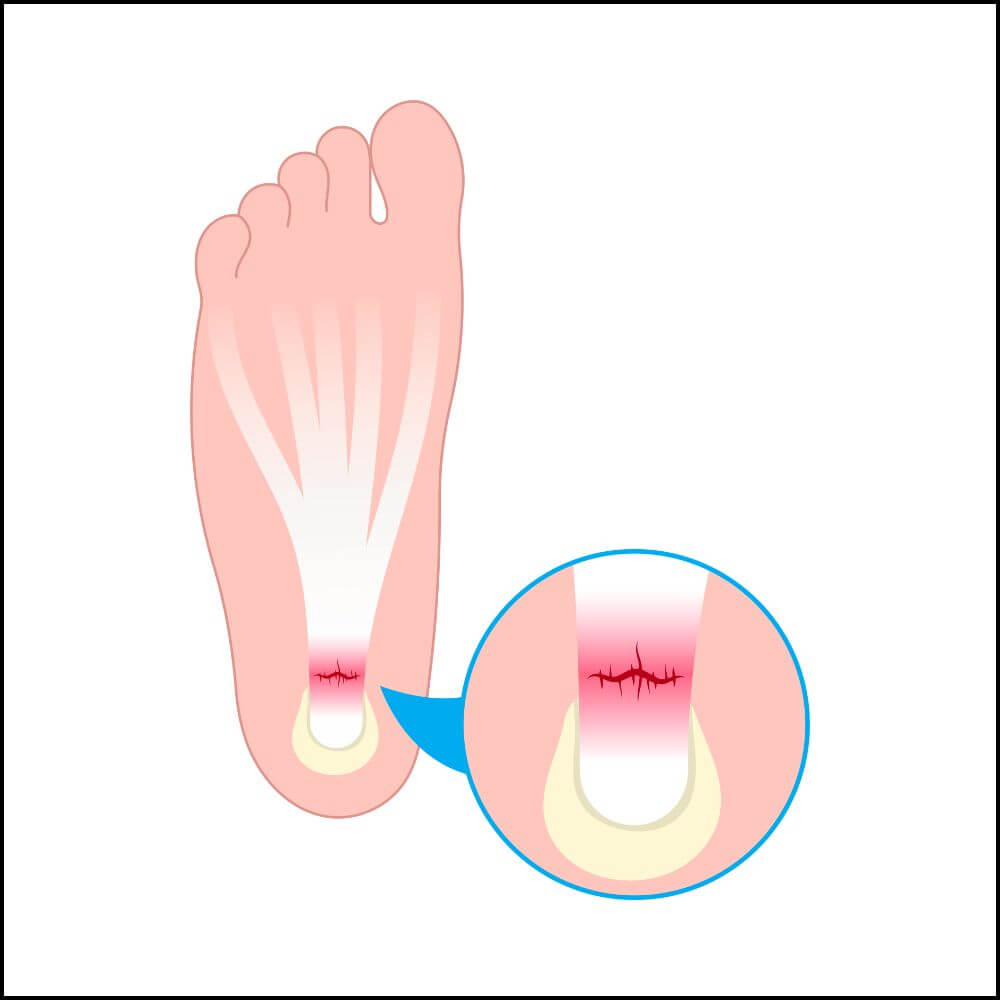 plantar fasciitis pain location