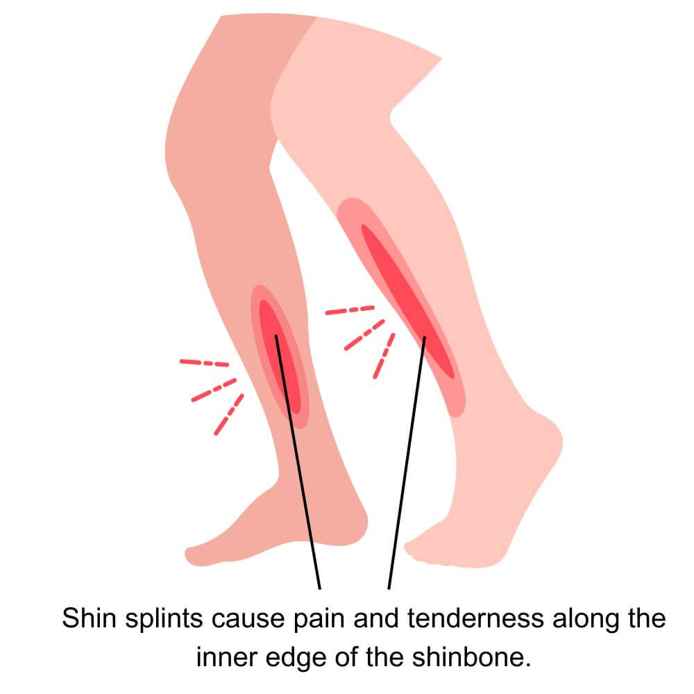 Shin Splints Diagram