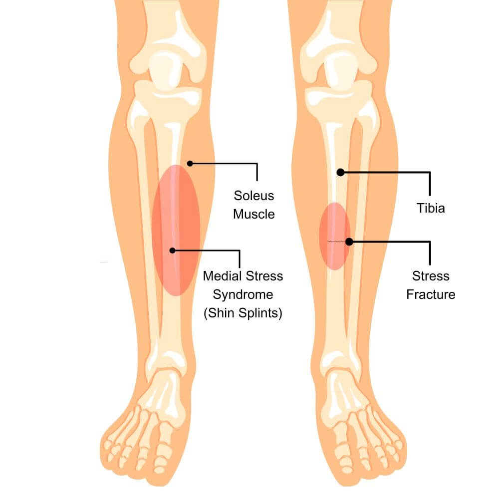 Shin Splints Vs. Stress Fractures