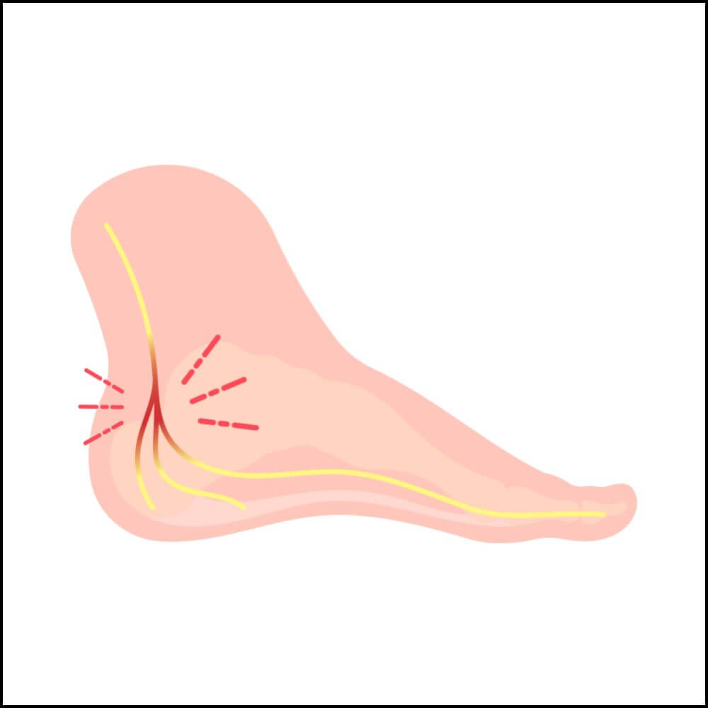 Tarsal Tunnel Syndrom Pain Location