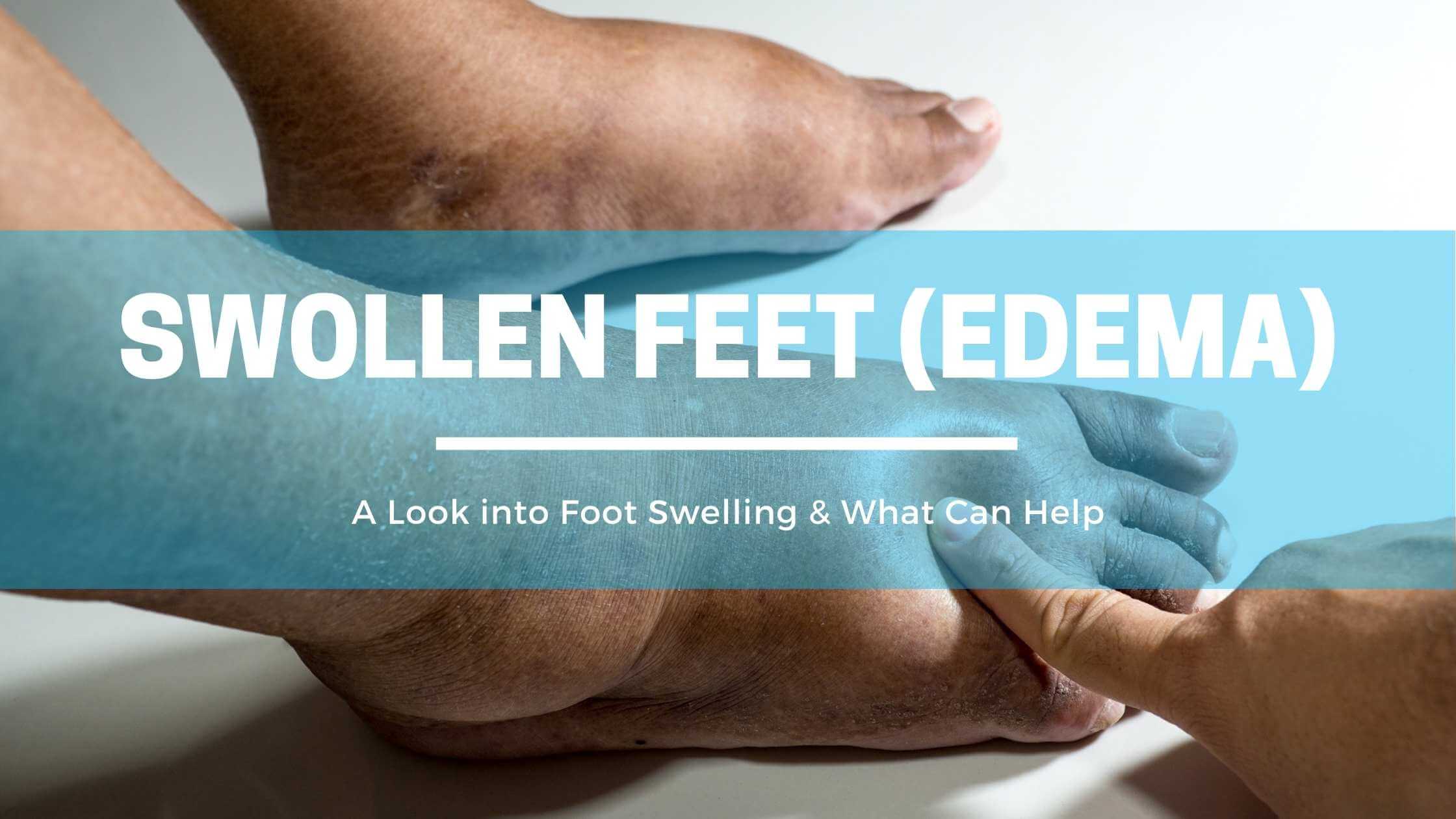 A Look into Swollen Feet & Ankles (Edema)