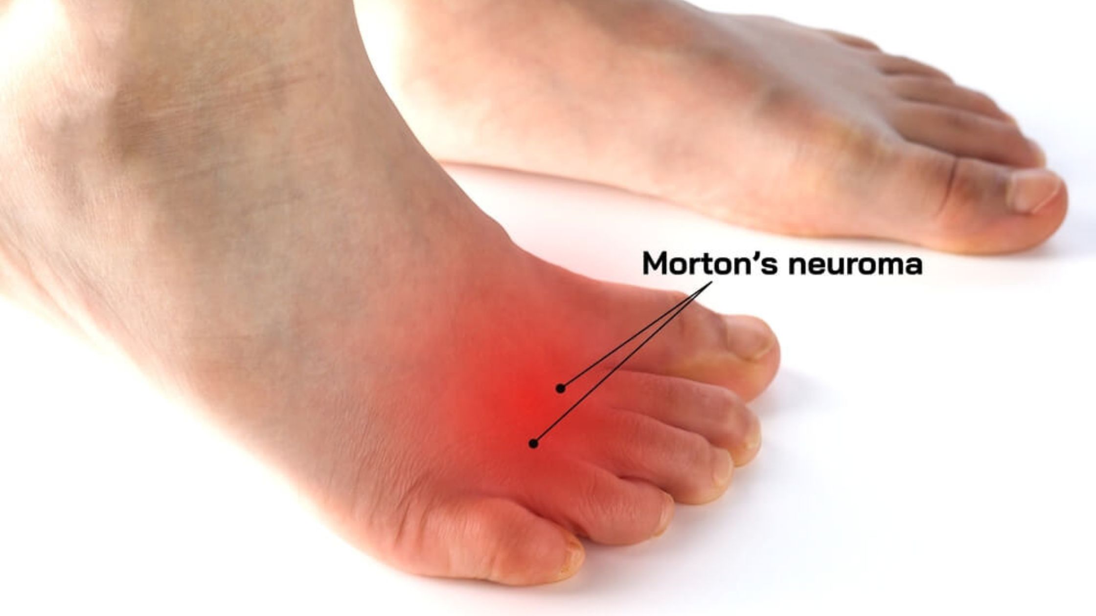 Can the Right Shoes Help with Morton's Neuroma Pain?
